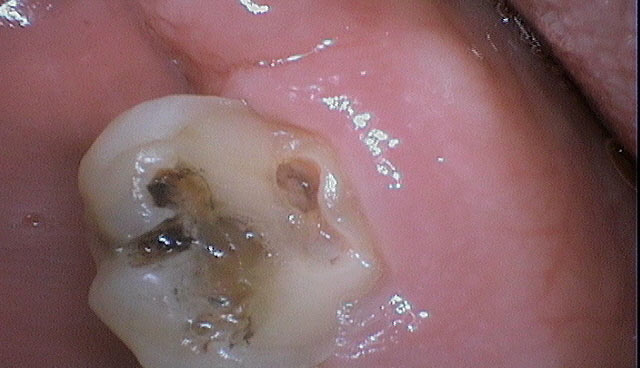 Prevention of Cavities Using Occlusal Sealants