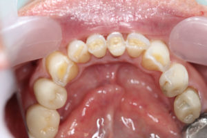 Dental-Implants-Burlington-Dr-Wong