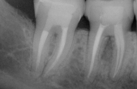 Dental Emergencies during COVID-19 Root-Canal-image