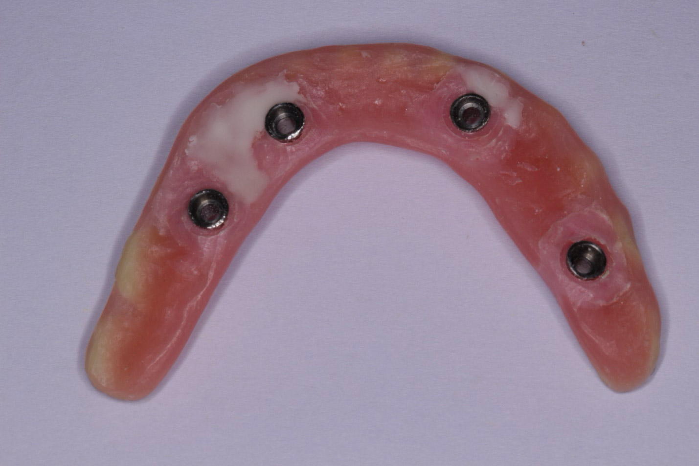 Full-Implant-Bridge-Dentistry-Burlington