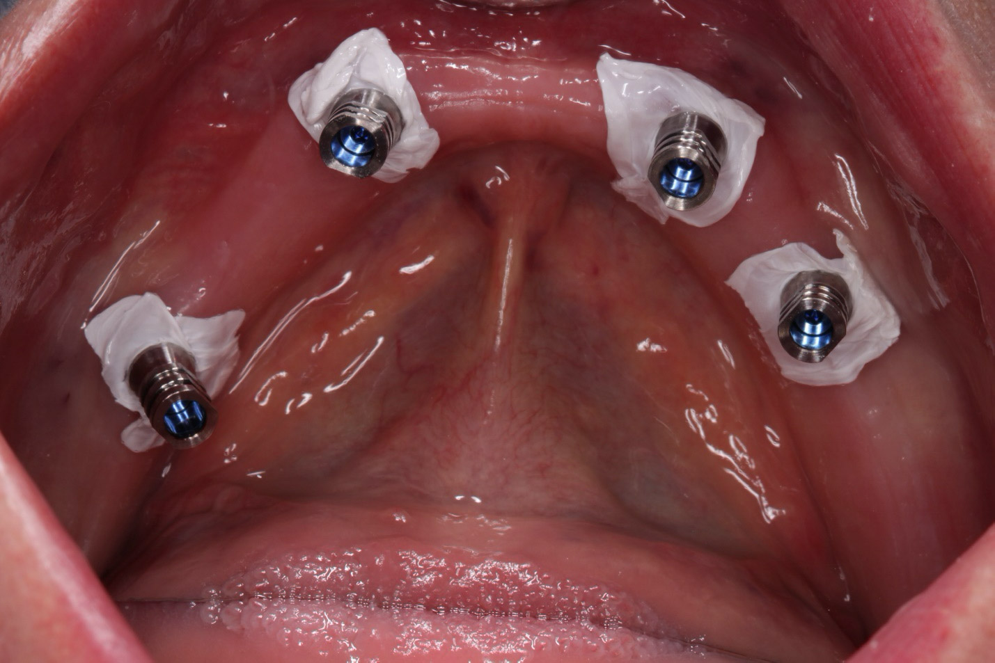 Full-Implant-Bridge-Dentistry