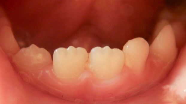 Permanent-Teeth-Burlington-Dentist