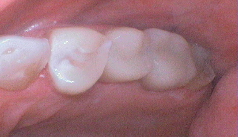 Fix-Sensitive-Teeth-Burlington