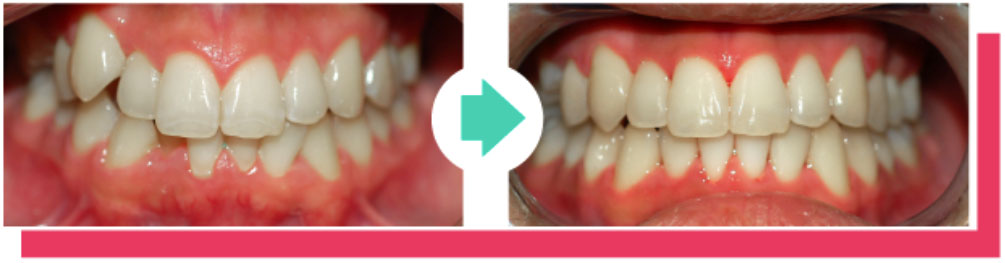 misaligned-teeth