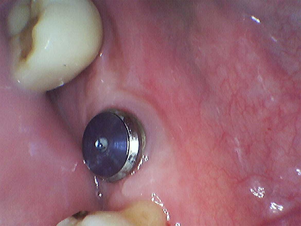 An implant case