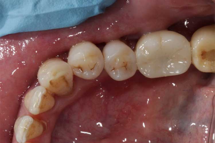 The crown was secured onto the implant and became functional.