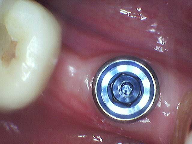 The implant without the cover.