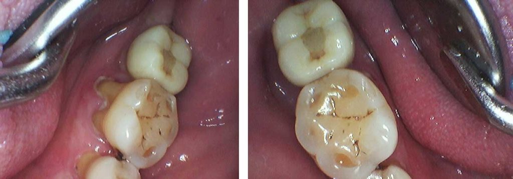 Severe bone loss in the first molar