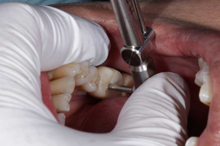 The crown was tightened onto the implant with a special wrench.