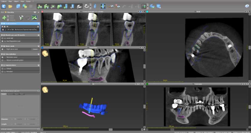 Treatment planning using 3D imaging