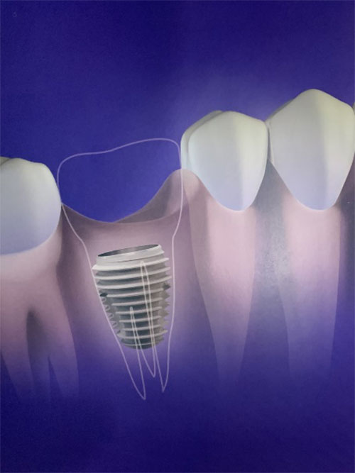 Image courtesy of Keystone Dental
