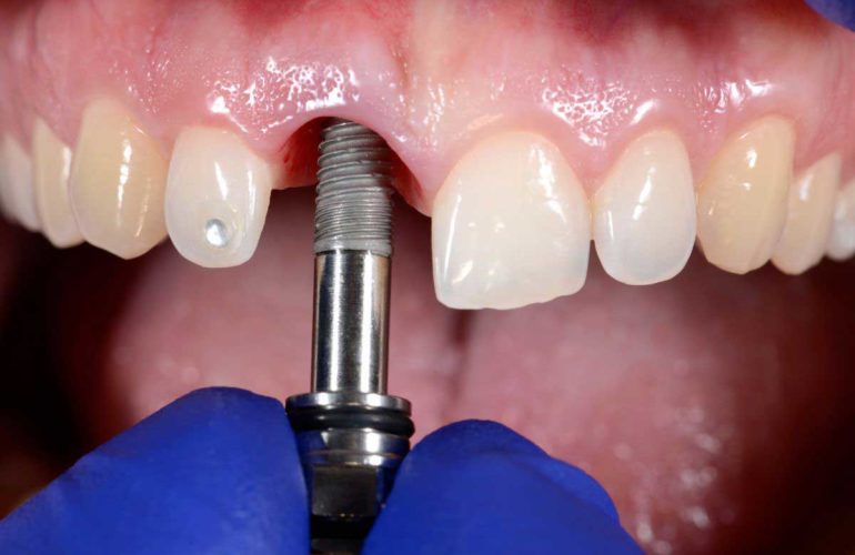 Prostheses support by dental implants