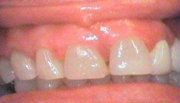 Incisor before extraction