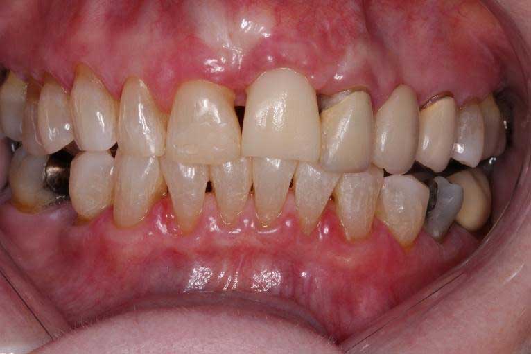 The upper left central incisor replaced with an immediate temporary crown attached to an implant