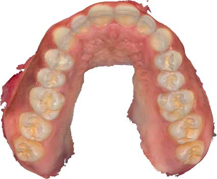 A digital impression of upper teeth taken by a Trios scanner