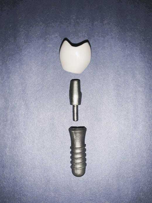 The “permanent” crown for the implant