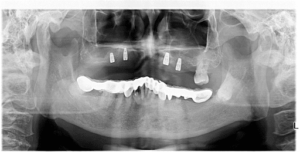 Implant Supported Upper Denture | Affinity Dental Care