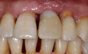 Affinity Dental Care | Implant for Upper Front Teeth