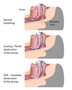 Affinity Dental Care - Snoring,Sleep Apnea and Breathing disorders